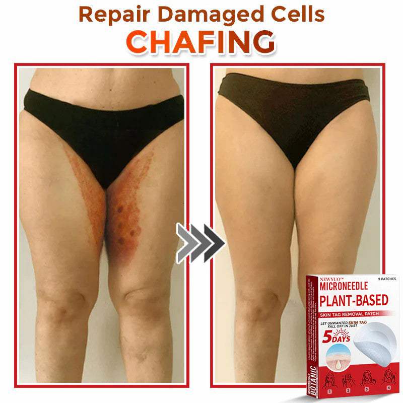 Newyuo® MicroNeedle Botanic Skin Tag Removal Patch