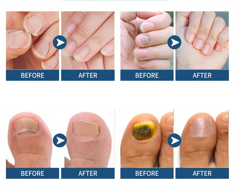 Health Care Patches – Repair and Strengthen Weak Nails