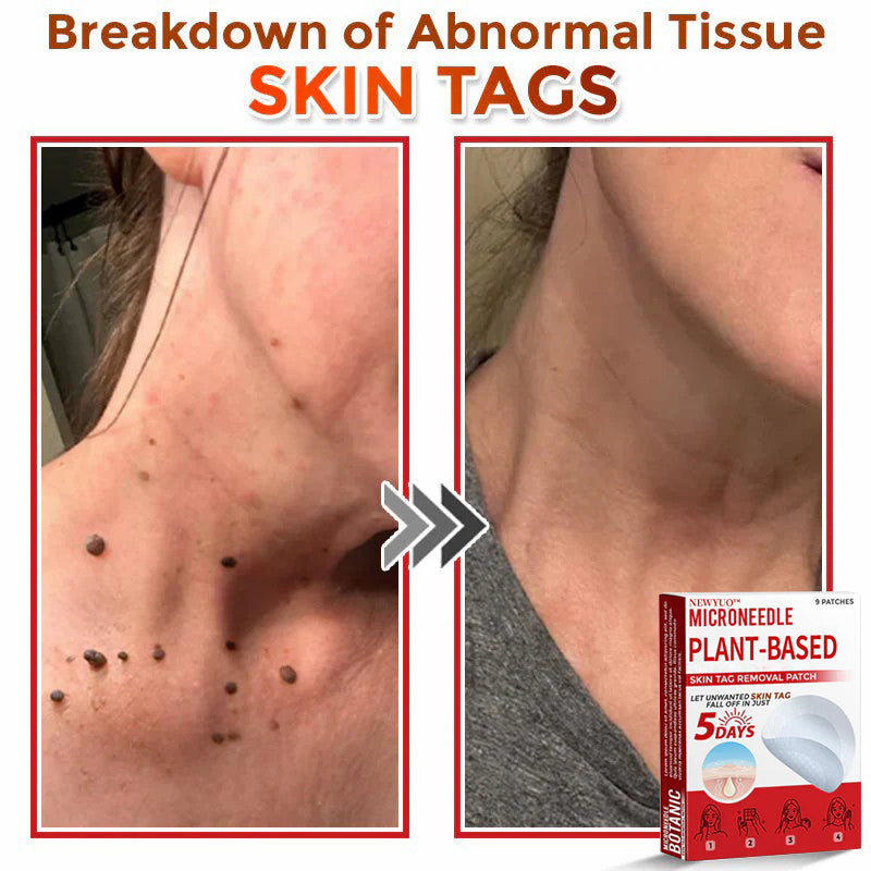 Newyuo® MicroNeedle Botanic Skin Tag Removal Patch
