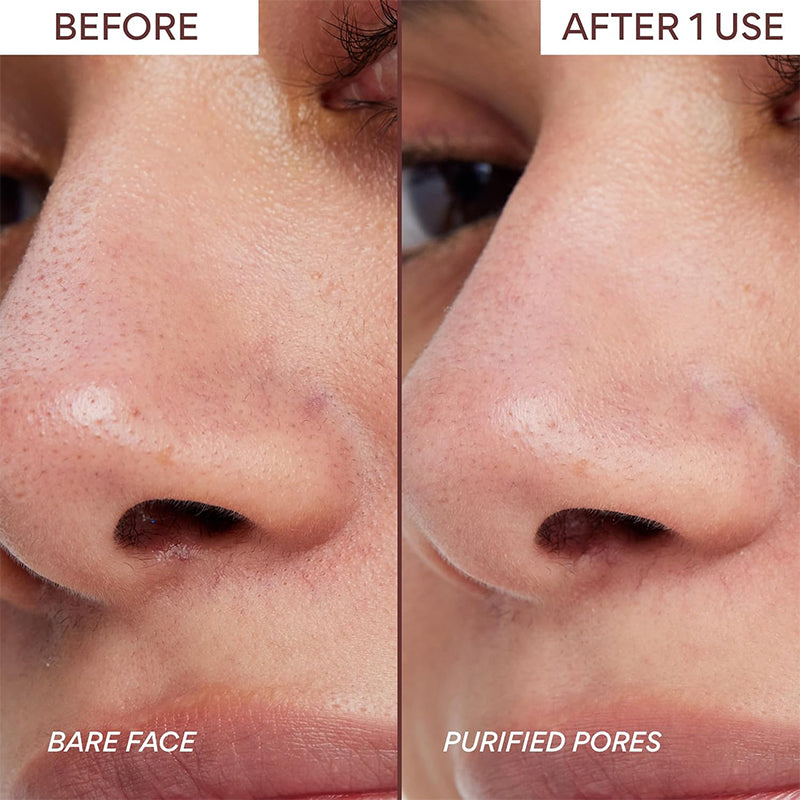 Newyuo™ Nose Pore Patches for Pores & Pimples | Medical-Grade Hydrocolloid (Buy 1 Get 1 Free)