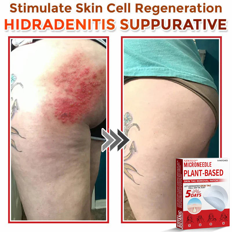 Newyuo® MicroNeedle Botanic Skin Tag Removal Patch