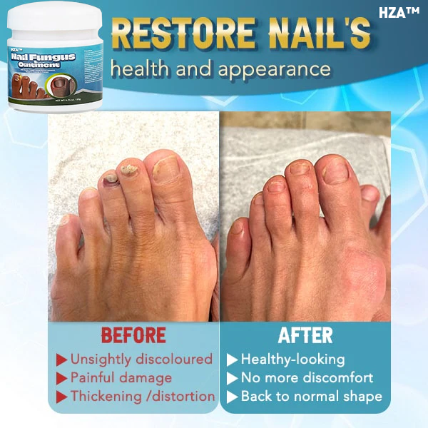 HZA™ 5X Quick-healing Nail Fungus Ointment