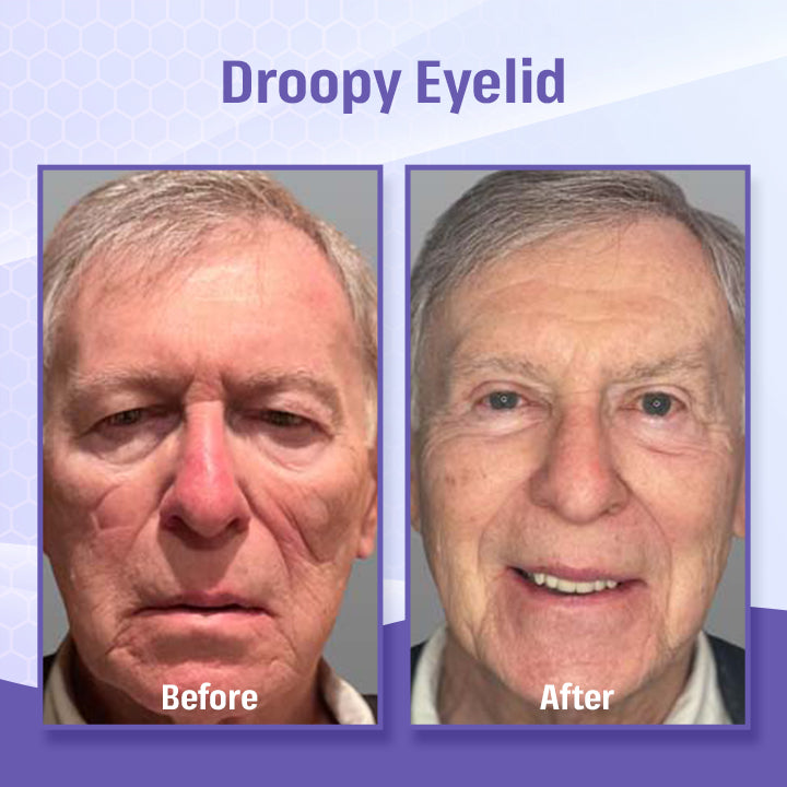 BBOJI™ Bee Poison Roller Eye Cream - 👨⚕️US Dermatologist Approved