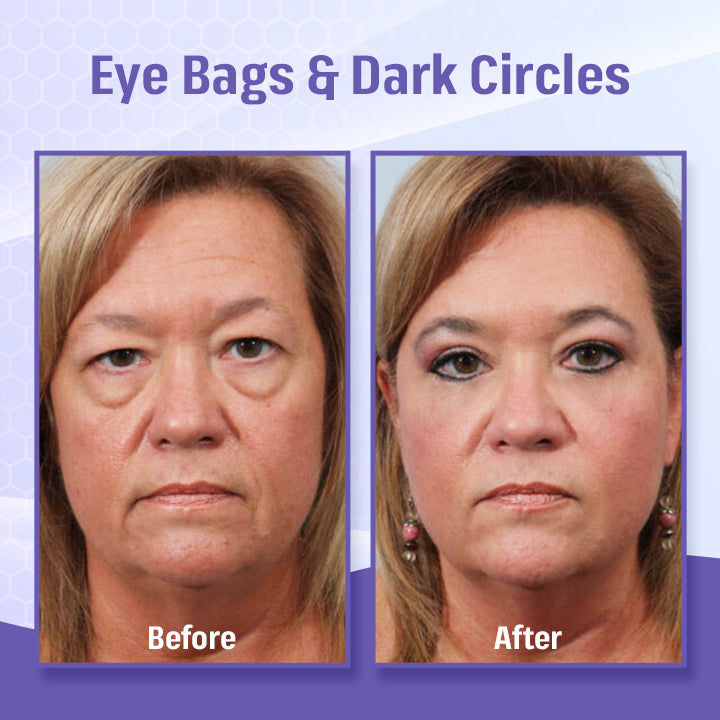 BBOJI™ Bee Poison Roller Eye Cream - 👨⚕️US Dermatologist Approved