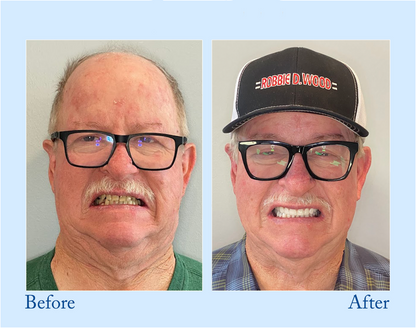 Digital Custom-Fit Functional Dentures