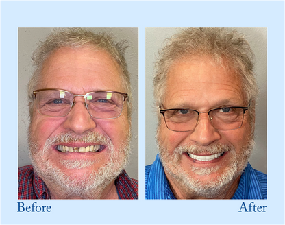 Digital Custom-Fit Functional Dentures