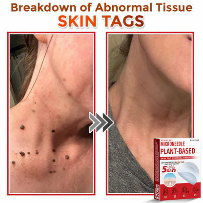 Newyuo® MicroNeedle Botanic Skin Tag Removal Patch