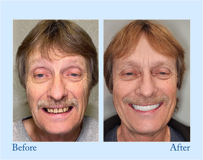 Digital Custom-Fit Functional Dentures