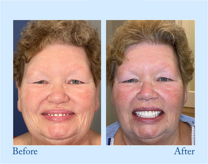 Digital Custom-Fit Functional Dentures