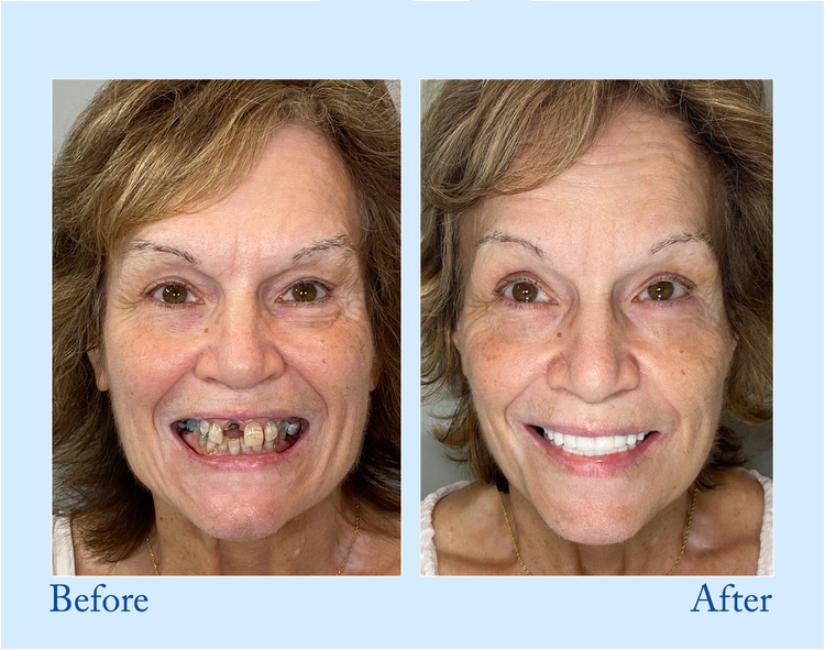 Digital Custom-Fit Functional Dentures