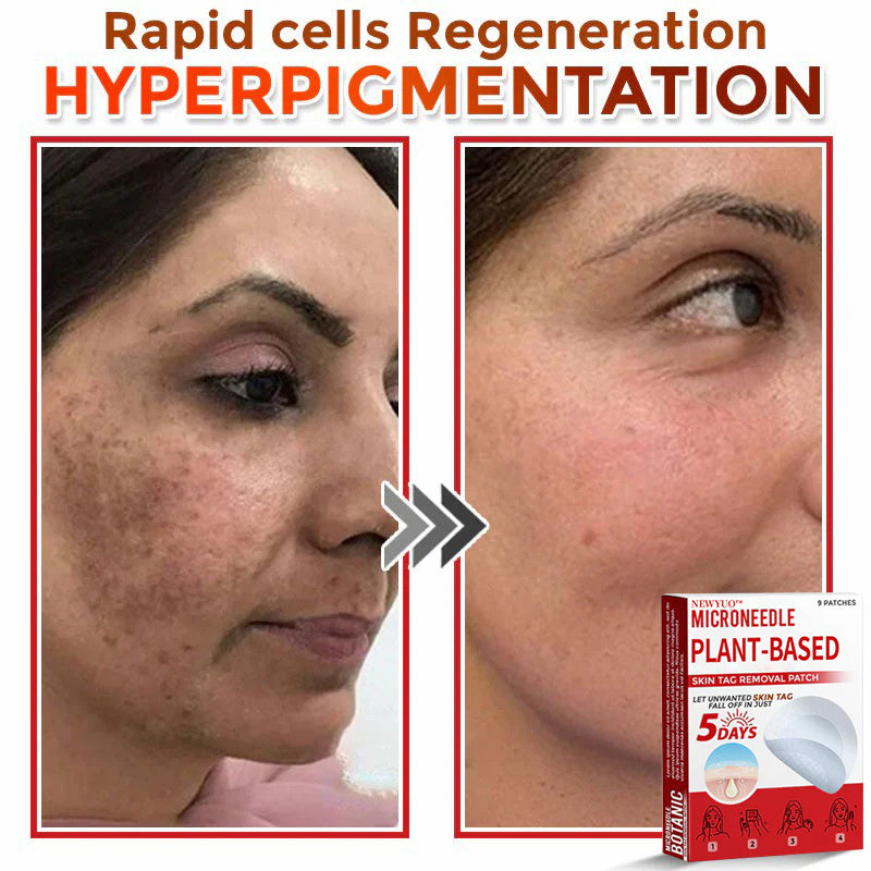 Newyuo® MicroNeedle Botanic Skin Tag Removal Patch