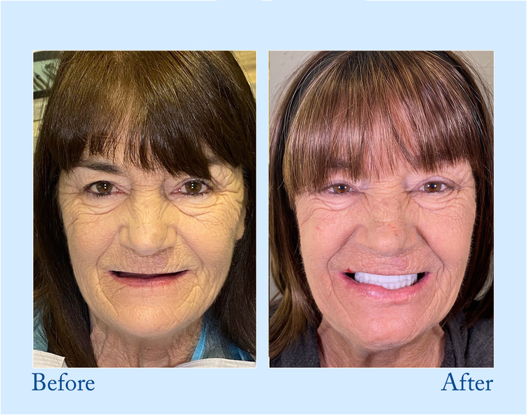 Digital Custom-Fit Functional Dentures