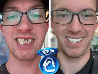 SmileFitPro™ — Custom-Fit, Affordable Denture Solution to Restore Your Natural Smile at Home